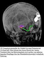 ABI (Auditory Brainstem Implant = Hirnstamm-Implantat